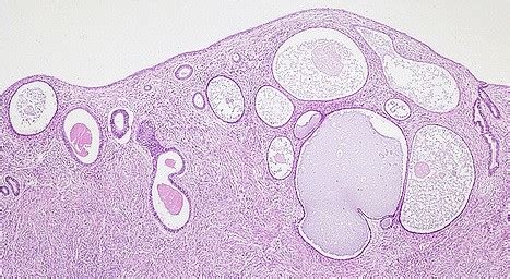 endometrio atrofico pathology outlines