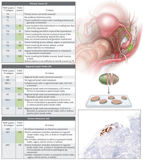 endometriod carcinoma icd 10