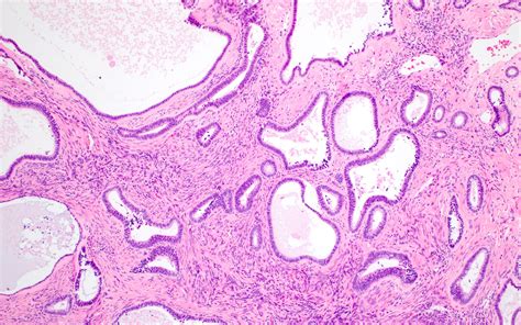 endometrioid cyst pathology outline