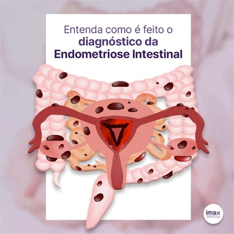 endometriose profunda cid 10