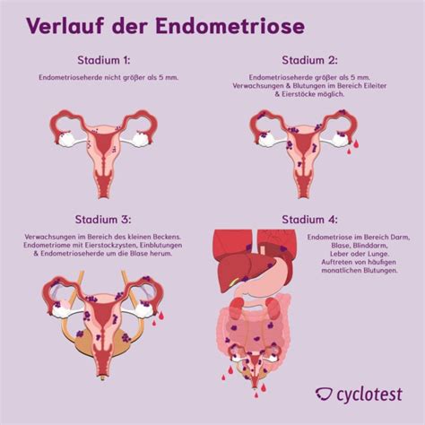 endometriose test kosten