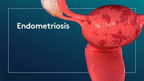 endometriosi come si riconosce