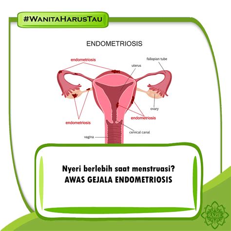 Endometriosis and its Treatment