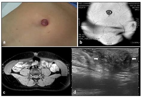 endometriosis abdominal wall ultrasound