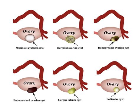 endometriosis and cysts on ovaries