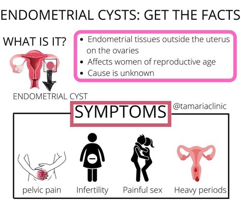endometriosis and ovarian cyst