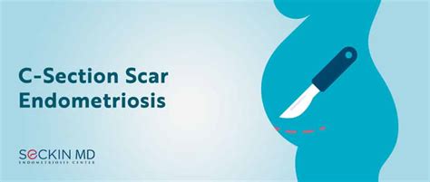 endometriosis c section scar