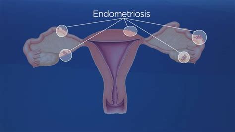 endometriosis foundation of canada