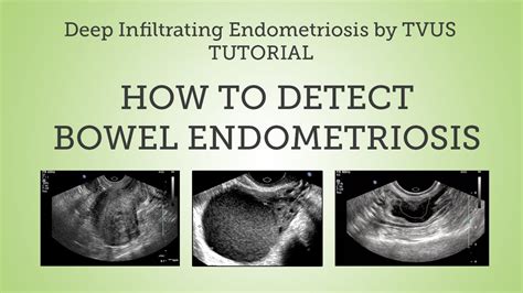 endometriosis in the colon