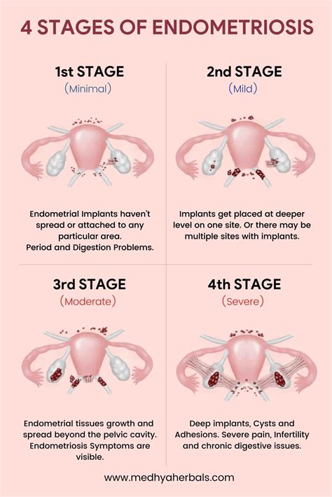 endometriosis of ovary symptoms