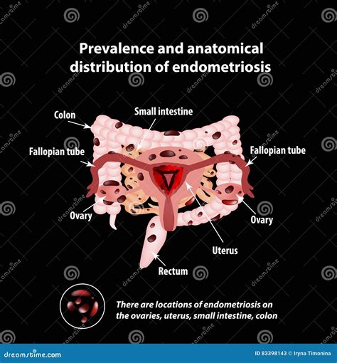 endometriosis on small bowel