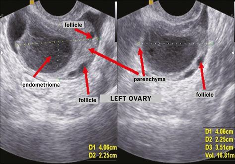 endometriosis ultrasound pics