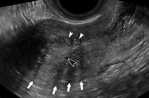 endometriosis ultrasound radiopaedia