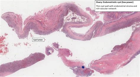 endometriotic cyst in ovary