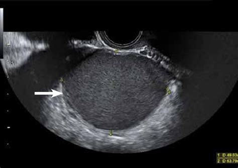 endometriotic cyst left ovary icd 10