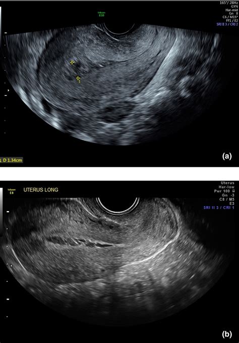 endometritis on ultrasound images