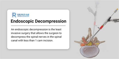 Endoscopic And Transpalpebral Decompression