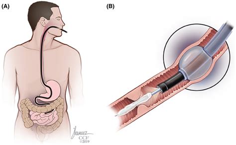 Endoscopic Balloon Dilation Small Bowel