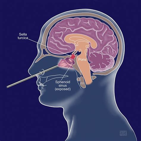 Endoscopic Biopsy Brain
