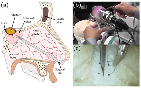 Endoscopic Endonasal Brain Surgery