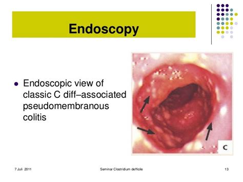 Endoscopic Finding C Diff