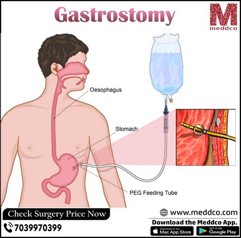 Endoscopic Gastrostomy Tube Placement Cpt Code