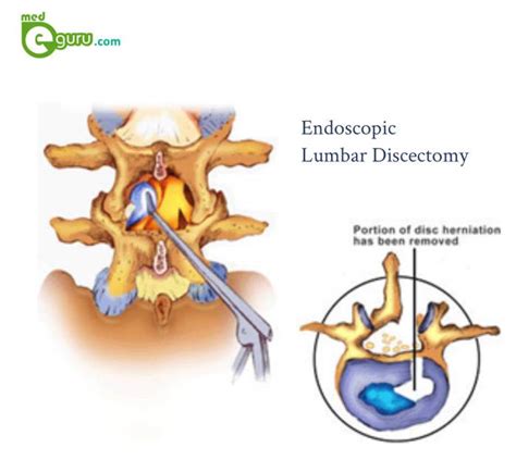 endoscopic microdiscectomy cpt code
