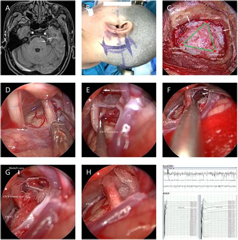 Endoscopic Microvascular Decompression For Trigeminal Neuralgia