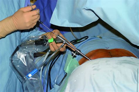 Endoscopic Spine Surgery Orthobullets