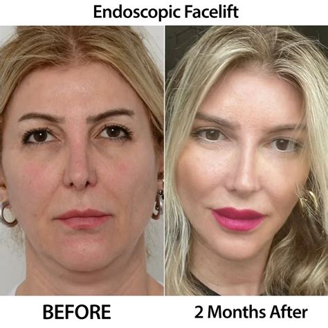 Endoscopic Surgery For Facelift
