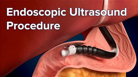 Unlocking Digestive Health: What to Expect from an Endoscopic Ultrasonography Procedure