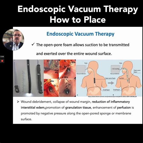 Endoscopic Vacuum Therapy