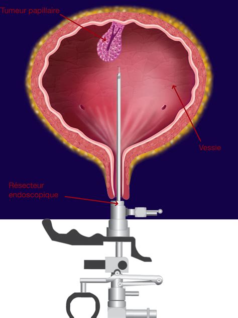 endoscopie de la vessie chez la femme