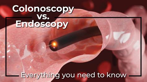 Endoscopy And Colonoscopy Together