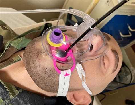 Endoscopy Anesthesia Reddit