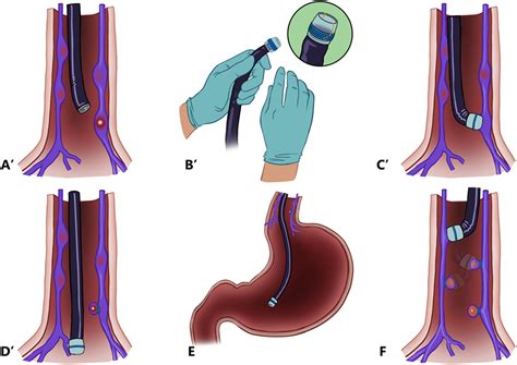 Endoscopy Application Of