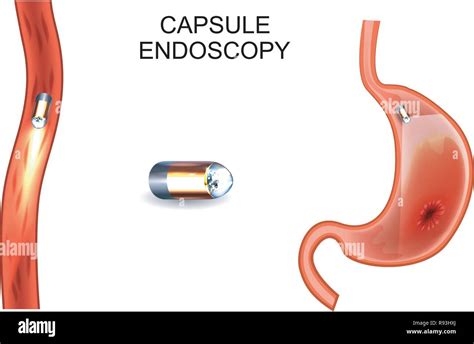 Endoscopy Capsule Image