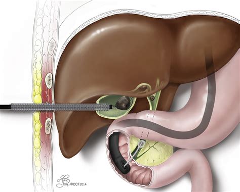Endoscopy For Cholelithiasis