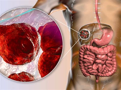Endoscopy For Liver Cysts