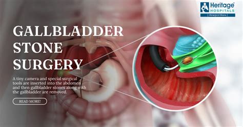 Endoscopy Gallbladder Stones
