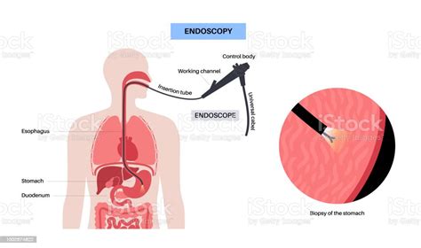 Endoscopy Gastroscopy Biopsy