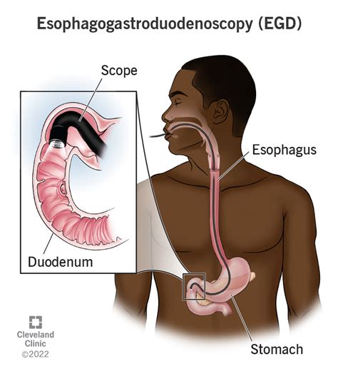 Endoscopy Or Egd