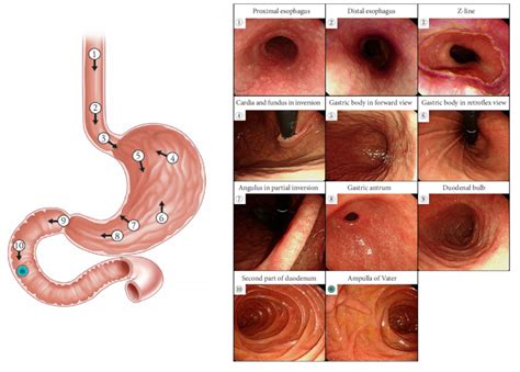 Endoscopy Pictures Of Normal Esophagus