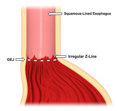 Endoscopy Z Line Irregular