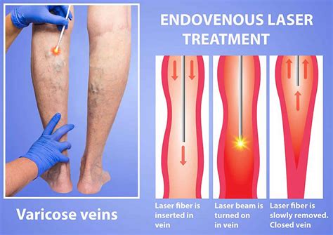 endovenous ablation therapy recovery