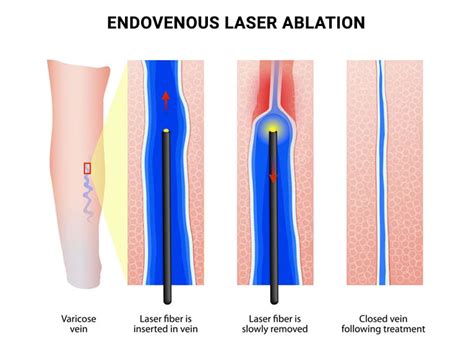 Say Goodbye to Varicose Veins: The Benefits of Endovenous Laser Ablation Explained