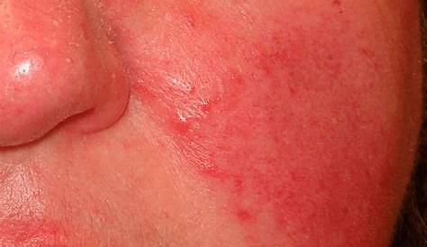 14 doenças que causam manchas vermelhas na pele (com fotos) - Tua Saúde