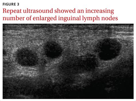 enlarged inguinal lymph nodes