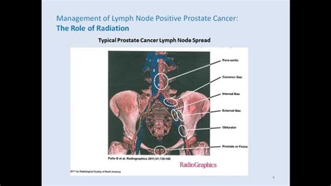 enlarged lymph nodes near prostate
