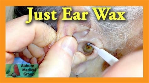 Ear Wax Removal by Suction Cleaning Dr Paulose FRCS (ENT) YouTube